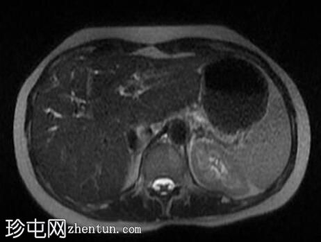 原发性硬化性胆管炎（PSC）