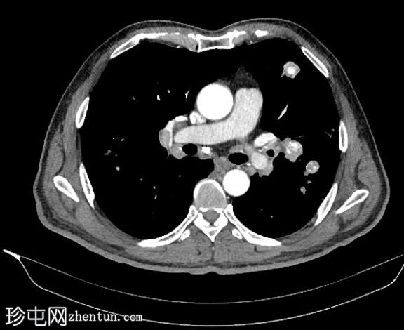 钙化肺和肝转移瘤