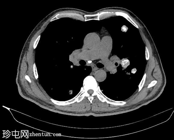 钙化肺和肝转移瘤