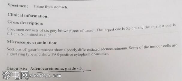 胃腺癌伴皮革状胃