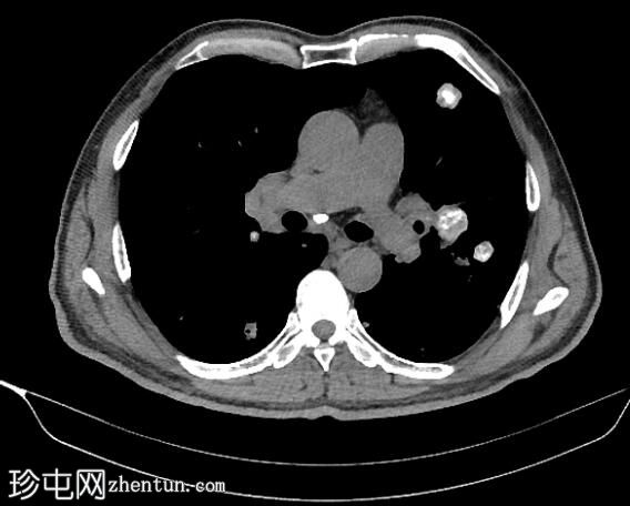 钙化肺和肝转移瘤