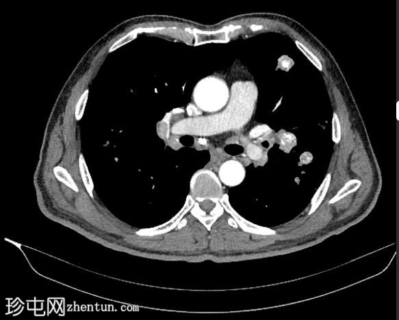 钙化肺和肝转移瘤