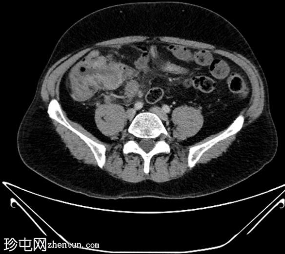 盲肠腺癌引起阑尾穿孔和回肠梗阻