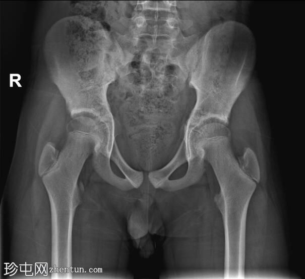 小转子撕脱性骨折