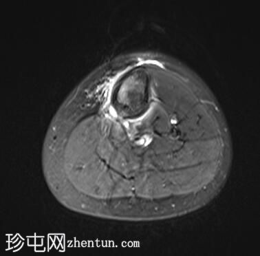 胫骨近端应力性损伤