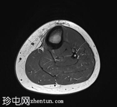 胫骨近端应力性损伤