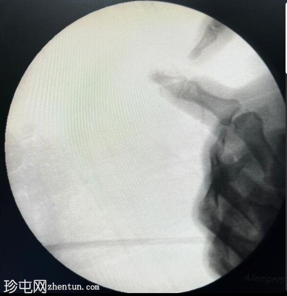 斯特纳病变