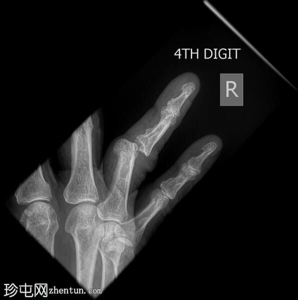 无名指指间关节脱位 - 内侧