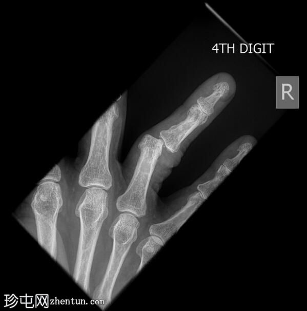 无名指指间关节脱位 - 内侧