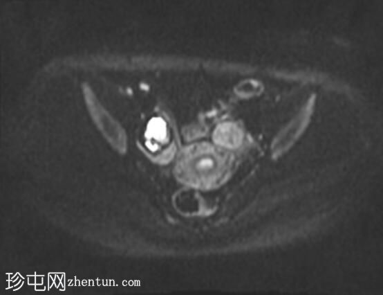 成熟囊性卵巢畸胎瘤