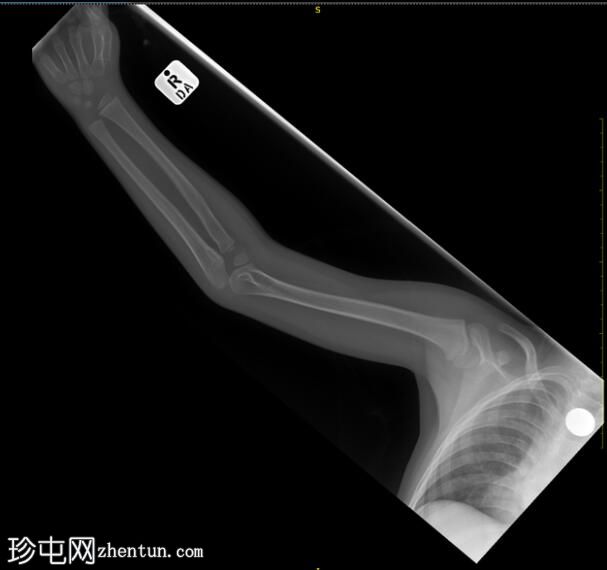 桡骨发育不良和摄入硬币