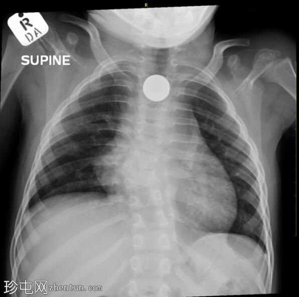 桡骨发育不良和摄入硬币