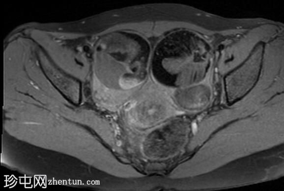 双侧成熟囊性卵巢畸胎瘤