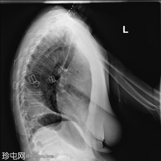 肺叶切除术后胸腔积液