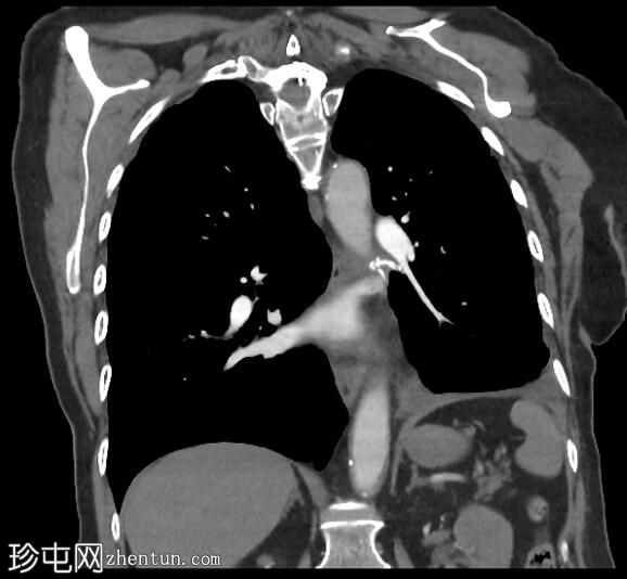 肺叶切除术后胸腔积液