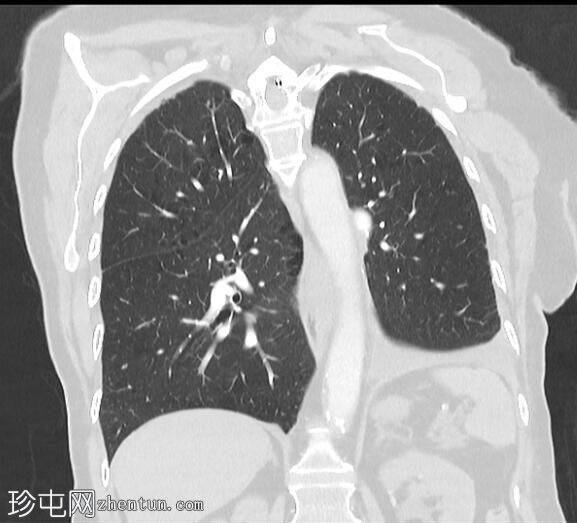 肺叶切除术后胸腔积液