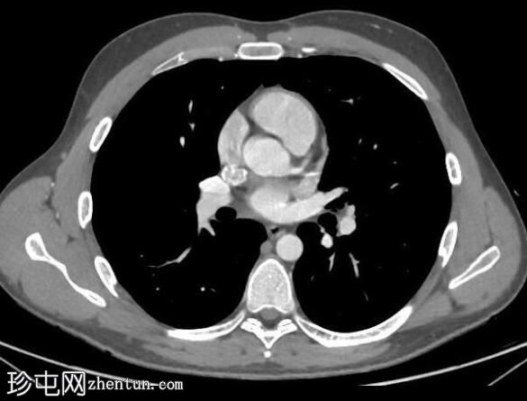 正常CT胸腹骨盆（年轻男性）