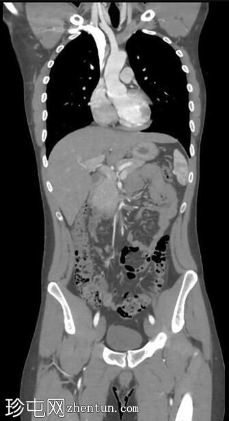 正常CT胸腹骨盆（年轻男性）
