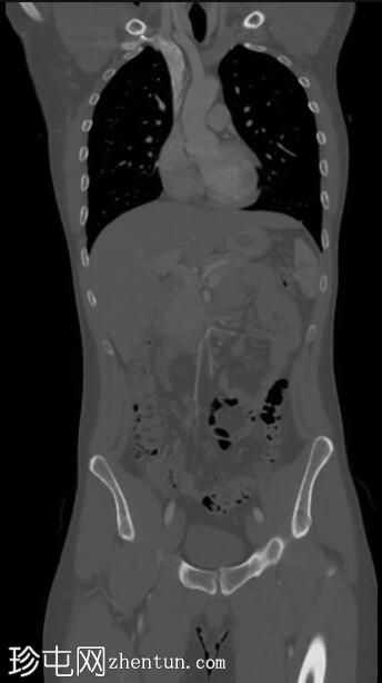 正常CT胸腹骨盆（年轻男性）