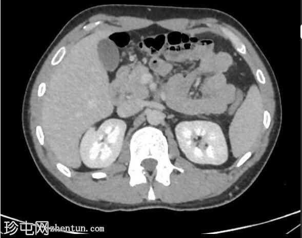 正常CT胸腹骨盆（年轻男性）