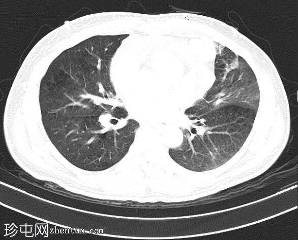 继发于上腔静脉阻塞的短暂椎体增强类似于骨转移