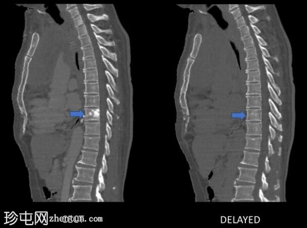 继发于上腔静脉阻塞的短暂椎体增强类似于骨转移