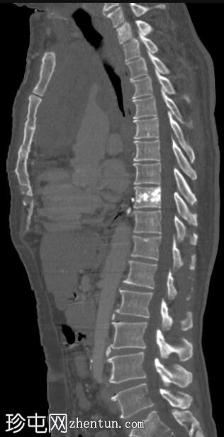 继发于上腔静脉阻塞的短暂椎体增强类似于骨转移