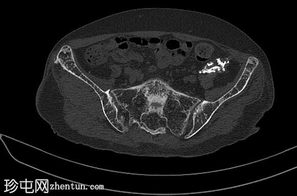 X线片上模拟软骨肿瘤的钙化失败肾移植