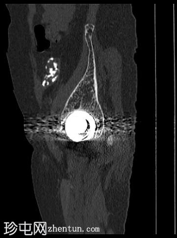 X线片上模拟软骨肿瘤的钙化失败肾移植