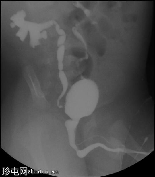 伴发双尿道及膀胱囊肿