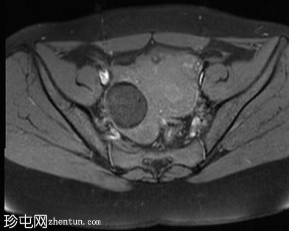 双侧卵巢成熟囊性畸胎瘤伴卵巢扭转