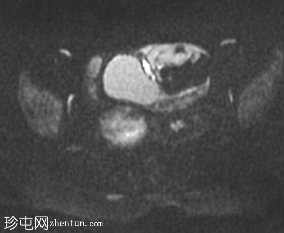 双侧卵巢成熟囊性畸胎瘤伴卵巢扭转