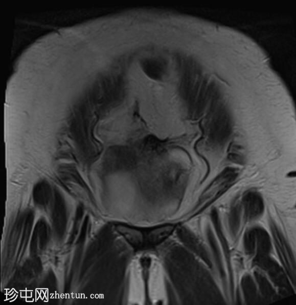 子宫内膜异位症、子宫腺肌症和腹膜包涵囊肿