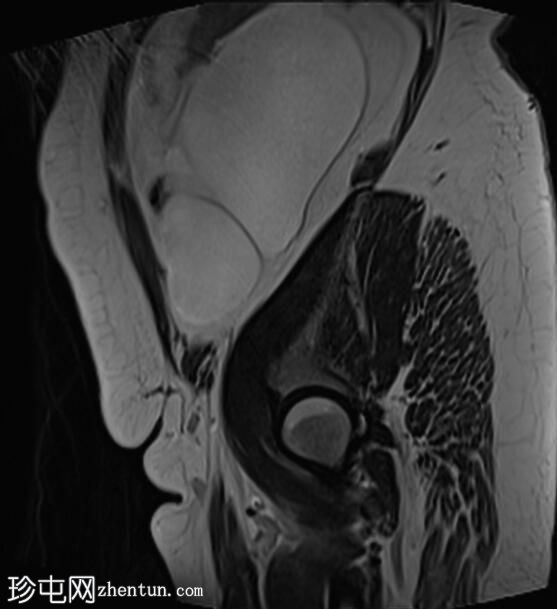 子宫内膜异位症、子宫腺肌症和腹膜包涵囊肿