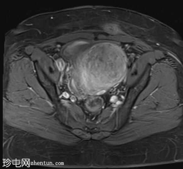 子宫内膜异位症、子宫腺肌症和腹膜包涵囊肿