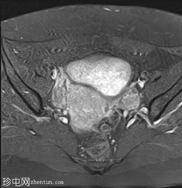 弥漫性子宫腺肌病伴卵巢纤维瘤及剖宫产疤痕憩室