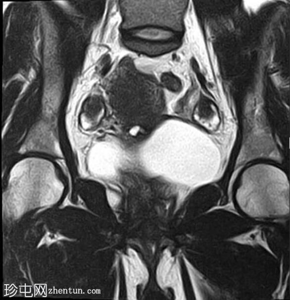 弥漫性子宫腺肌病伴卵巢纤维瘤及剖宫产疤痕憩室