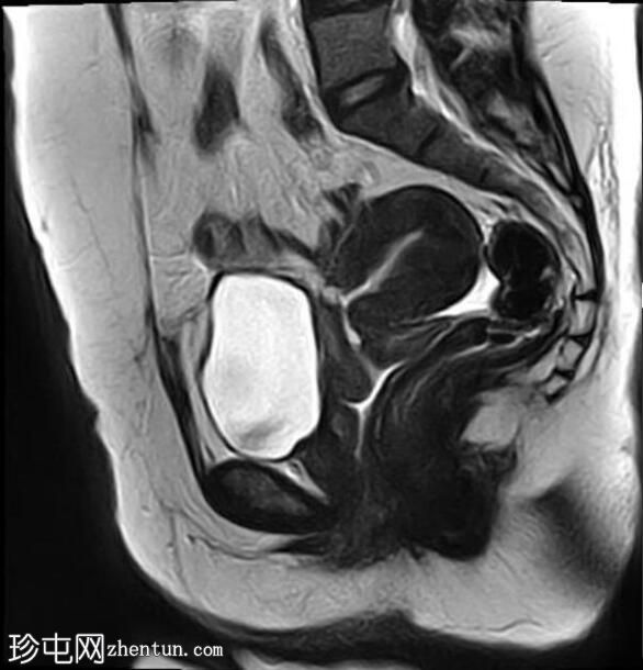 弥漫性子宫腺肌病伴卵巢纤维瘤及剖宫产疤痕憩室