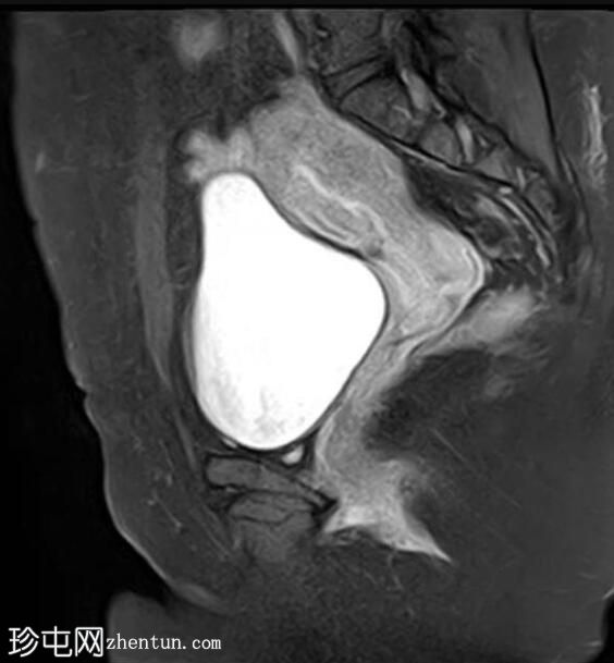 弥漫性子宫腺肌病伴卵巢纤维瘤及剖宫产疤痕憩室