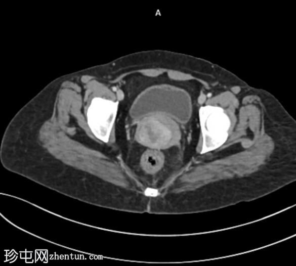 子宫内膜息肉脱垂