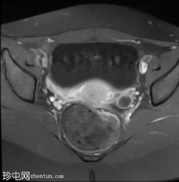 卵巢子宫内膜异位瘤伴局灶性子宫腺肌症