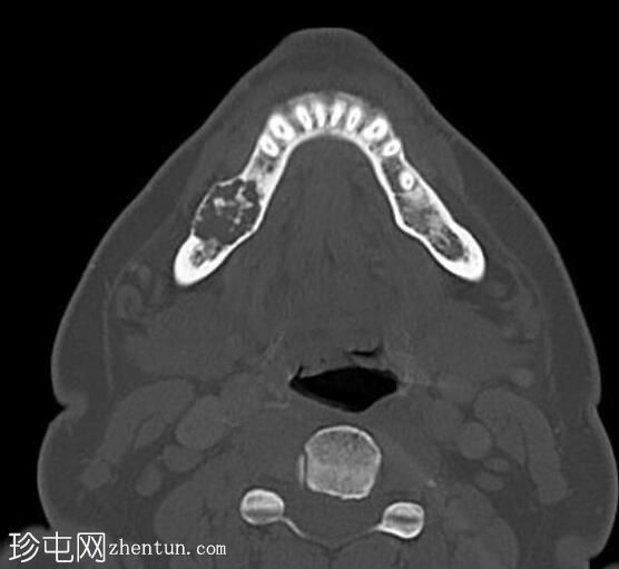 成釉细胞瘤 - 下颌骨