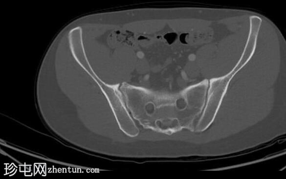 胸腹骨盆CT正常(年轻男性)