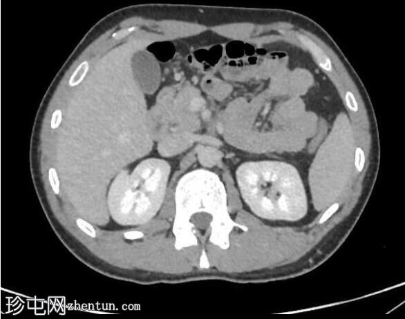 胸腹骨盆CT正常(年轻男性)