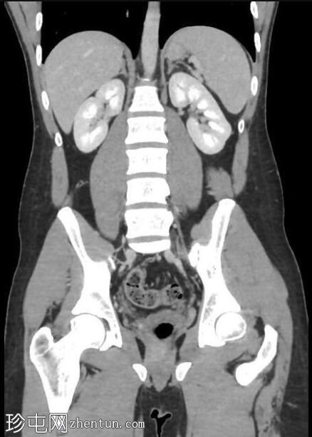 胸腹骨盆CT正常(年轻男性)