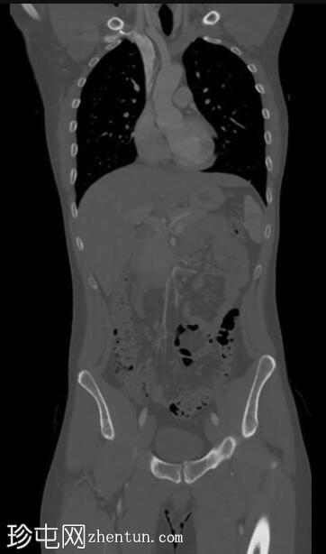 胸腹骨盆CT正常(年轻男性)