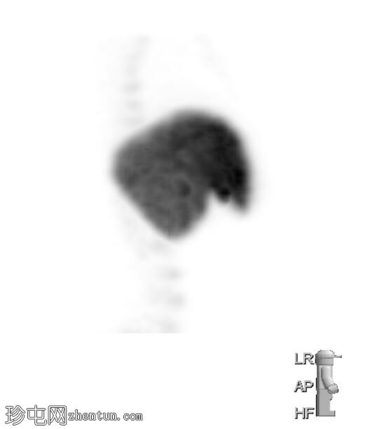 脾脏（Tc-99m硫胶体扫描）