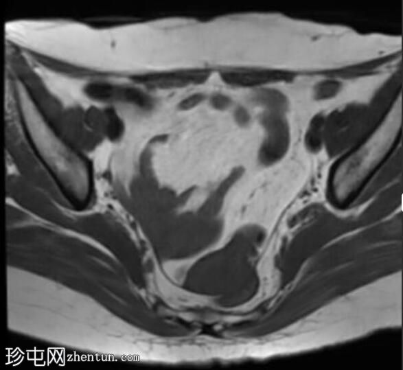 管状绒毛状腺瘤