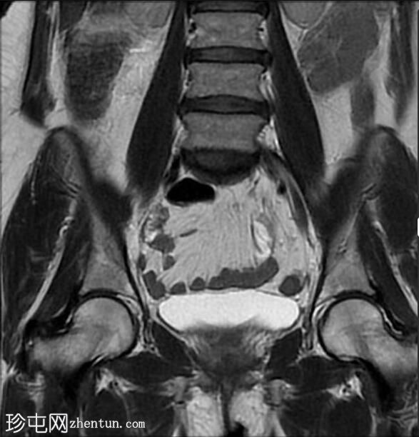 管状绒毛状腺瘤