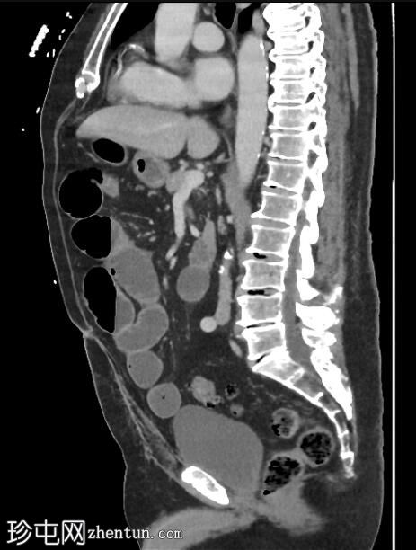 回肠套叠-回肠末端神经内分泌肿瘤